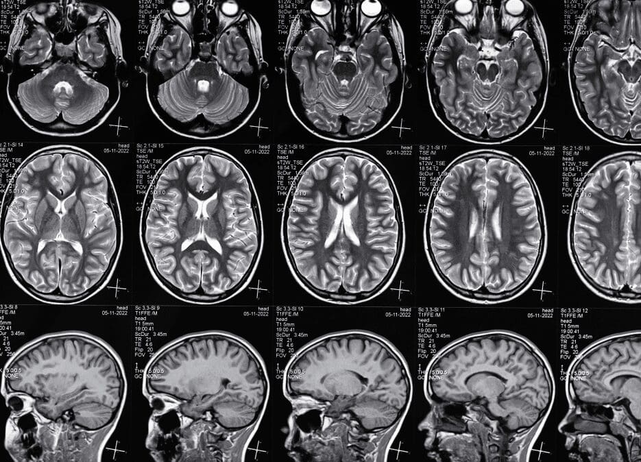 How-is-a-TBI-caused Traumatic brain injury MRI